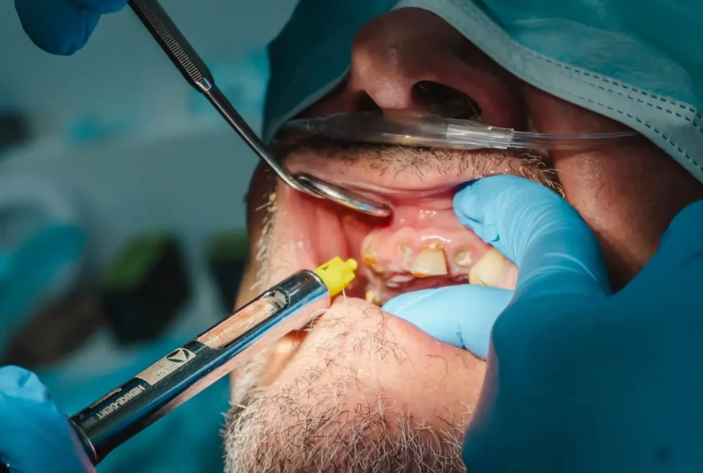 Urgencias Dentales - Dental Emergencies - Urgences Dentaires