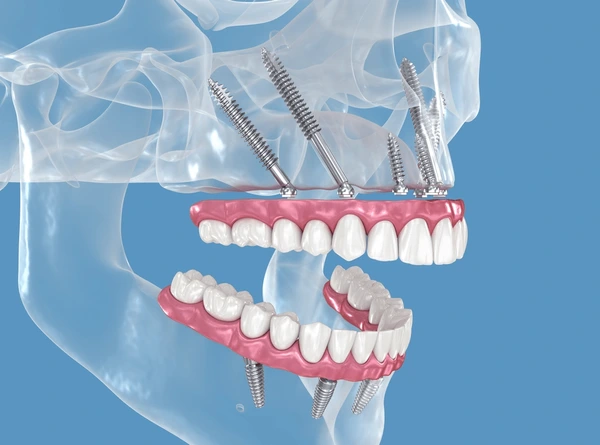 Zigomaticos - Zygomatic - Zygomatiques
