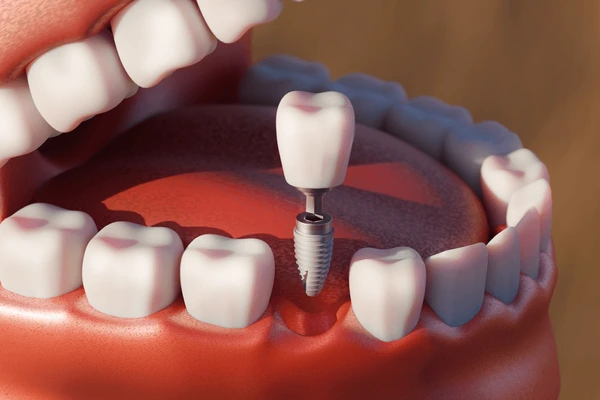 Implantología - Implantology - Implantologie